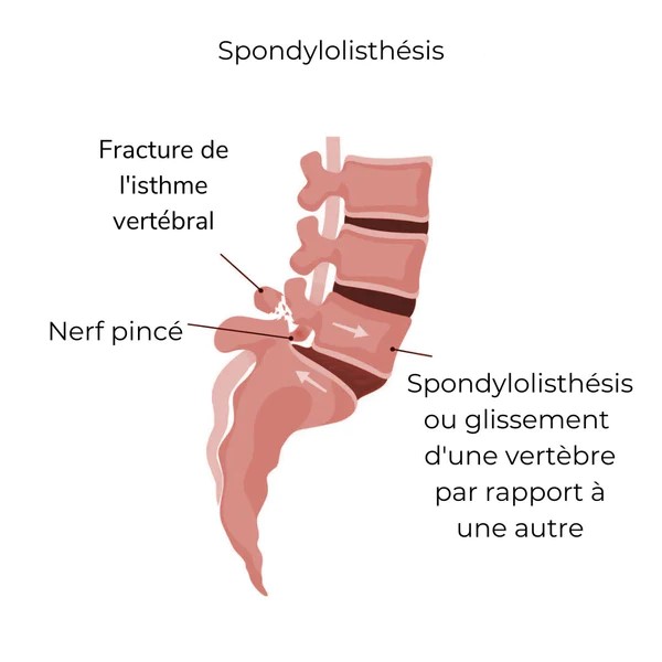 spondylolisthesis